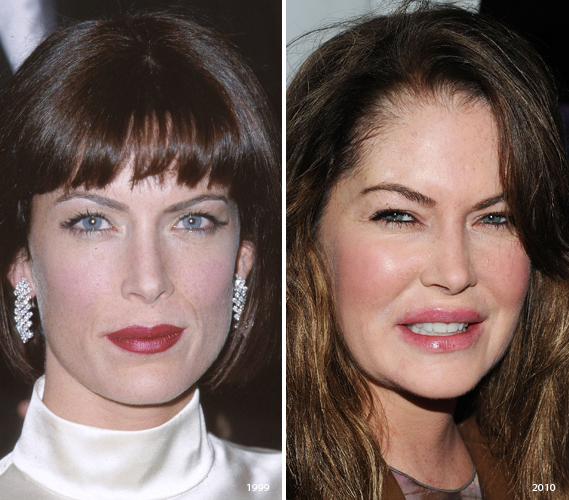 lara-flynn_boyle-plastic_surgery-before-and-after